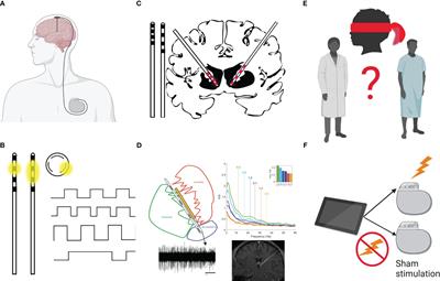 Deep brain stimulation for the treatment of substance use disorders: a promising approach requiring caution